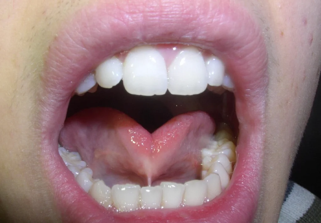 Example of Ankyloglossia